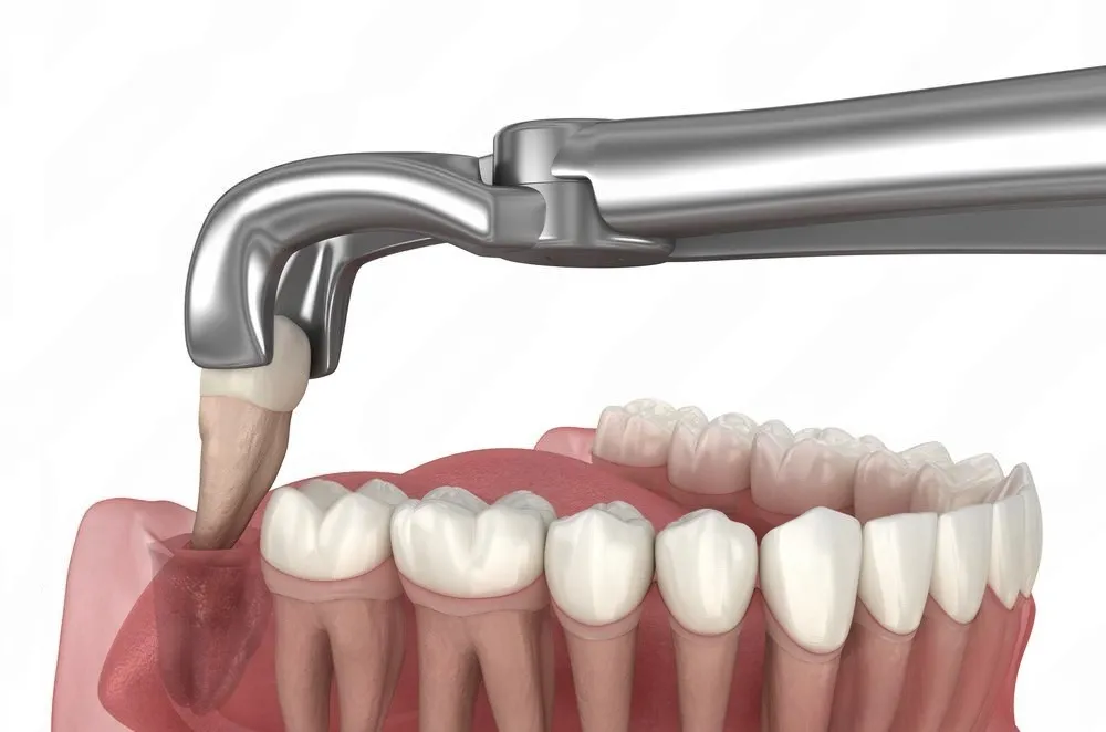 Padmanaabh Dental Clinic and Implant Centre - Best Root Canal ...